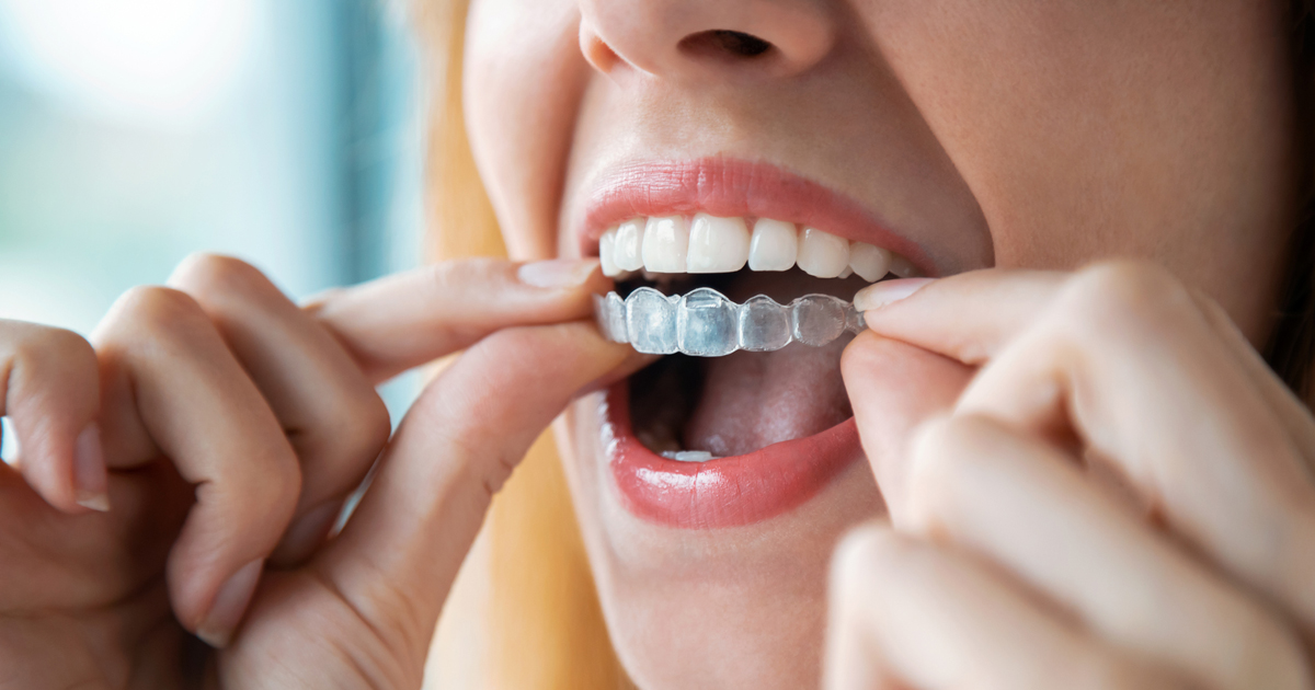 Is Invisalign® as effective as traditional braces? - Smiles 4