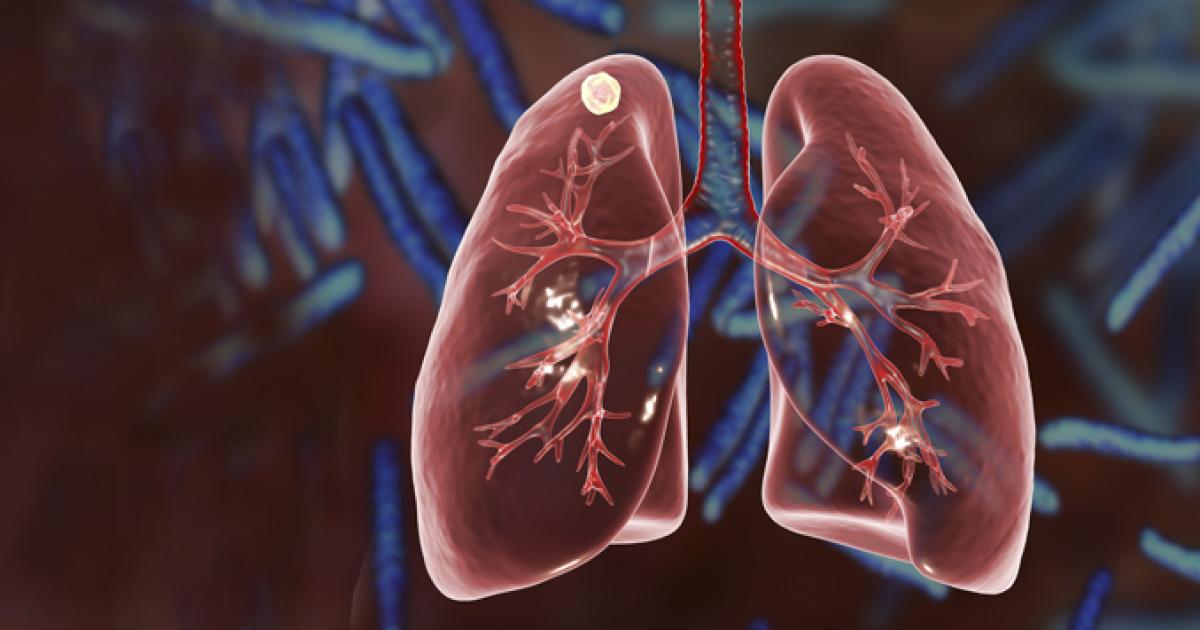 Lung Nodules And How They Relate To Lung Cancer | El Camino Health