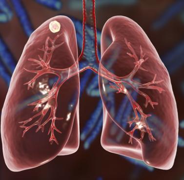 Lung Nodules and How They Relate to Lung Cancer