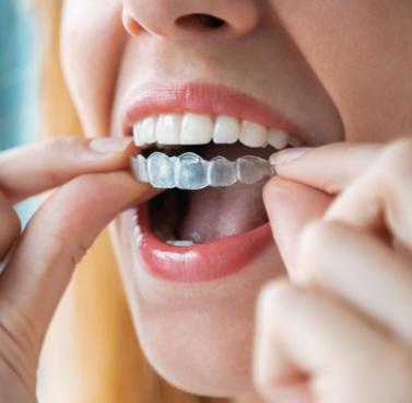 Teeth Aligners: Do They Work?